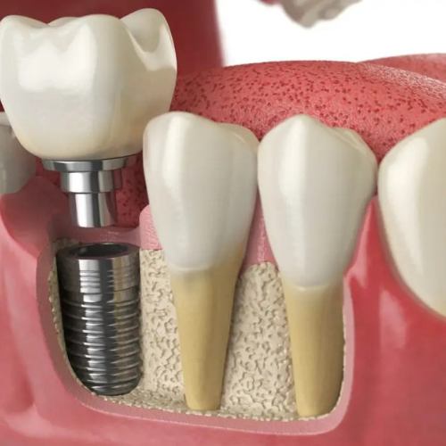 Best Dental Implant Services in Secunderabad