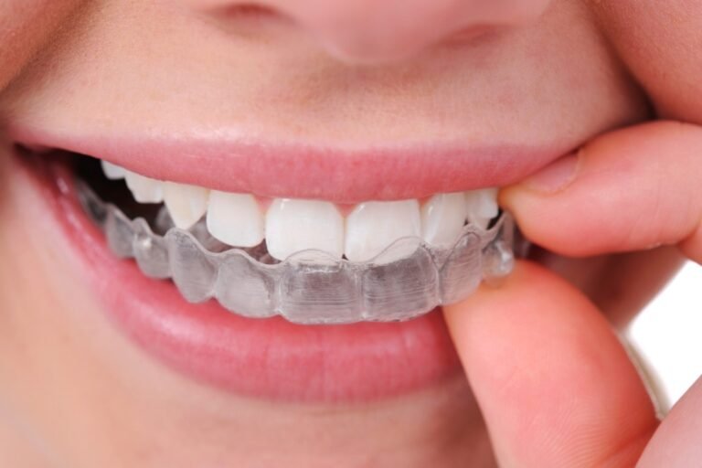 Best Invisalign Treatment in Hyderabad